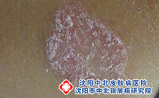 银屑病对病人有什么危害，沈阳银屑病医院排行榜