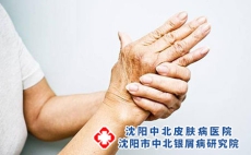 银屑病会发生在手掌和脚掌吗?