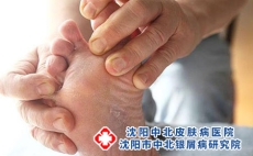 银屑病与手掌和脚掌之间的关系