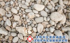 沈阳中北医院哪个医生治疗牛皮癣好?