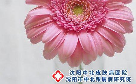 女性牛皮癣患者怀孕应该注意什么?如何预防?